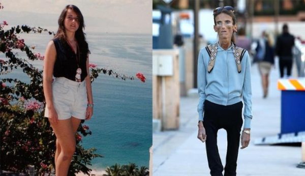 HE.. The World’s Thinnest Woman’s Battle Against Anorexia Will Leave You Speechless!