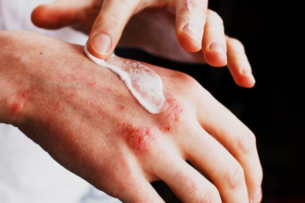 HT6. Warning signs you should never ignore on your skin