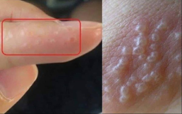 HT6. If You See These Painful Red Bumps, You May Have Dyshidrotic Eczema