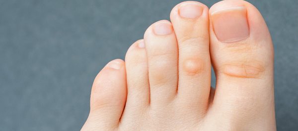 HE. Causes and treatments for thick toenails