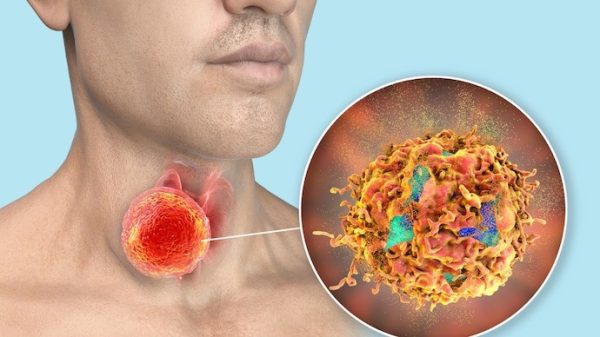 HT6. Rising Throat Cancer Risk Linked to HPV: What You Need to Know and How to Stay Protected