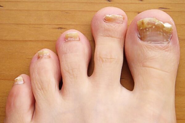 HT6. Causes and treatments for thick toenails