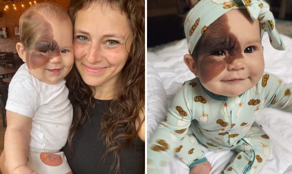 VHL. Mom on a mission to show daughter with extremely rare birthmark that she is beautiful