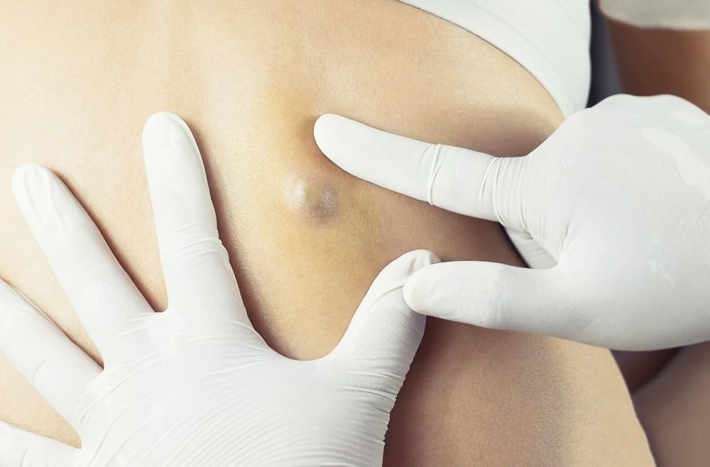 ST13. Understanding Skin Cysts: Causes, Treatments, and Medical Advice from Dermatologists
