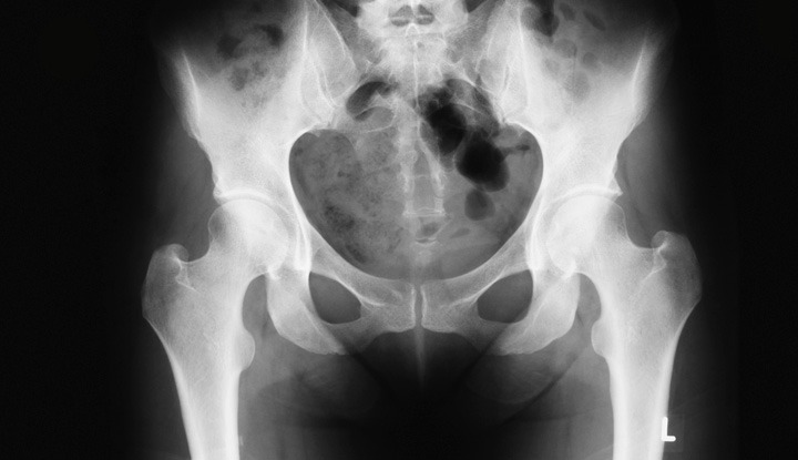 HT17. What Do You Notice? Understanding Pelvic X-Rays and Bone Abnormalities