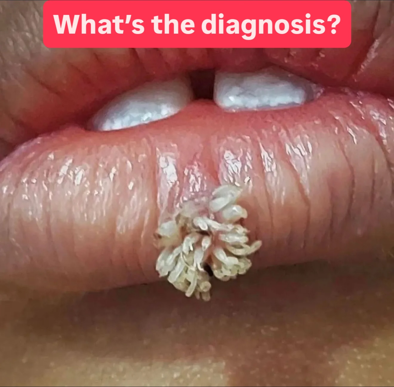 HT17. Don’t Underestimate It: Recognizing the Early Signs of Oral Can…