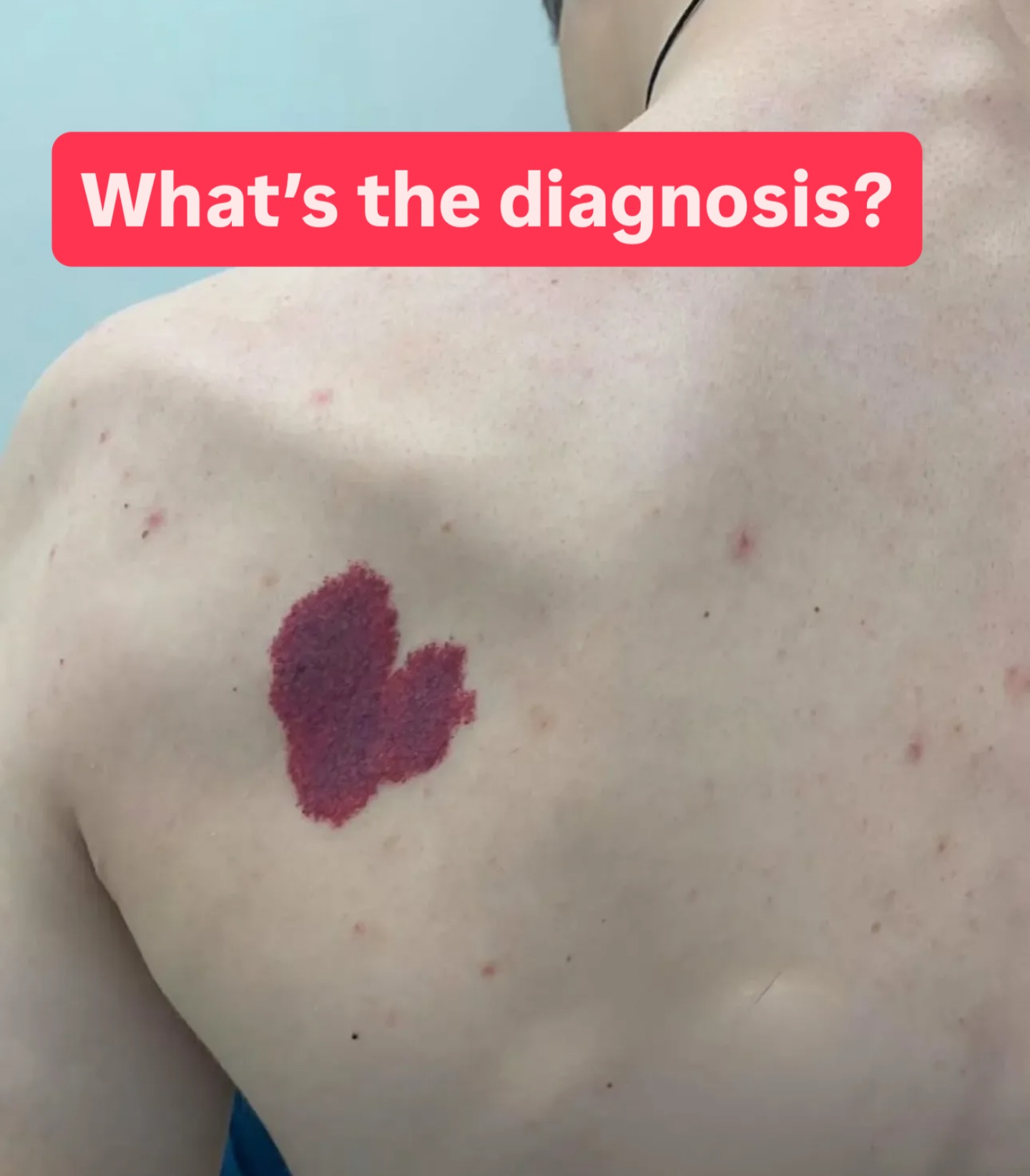 HT17. Port-Wine Stain: Causes, Symptoms, and Treatment Options