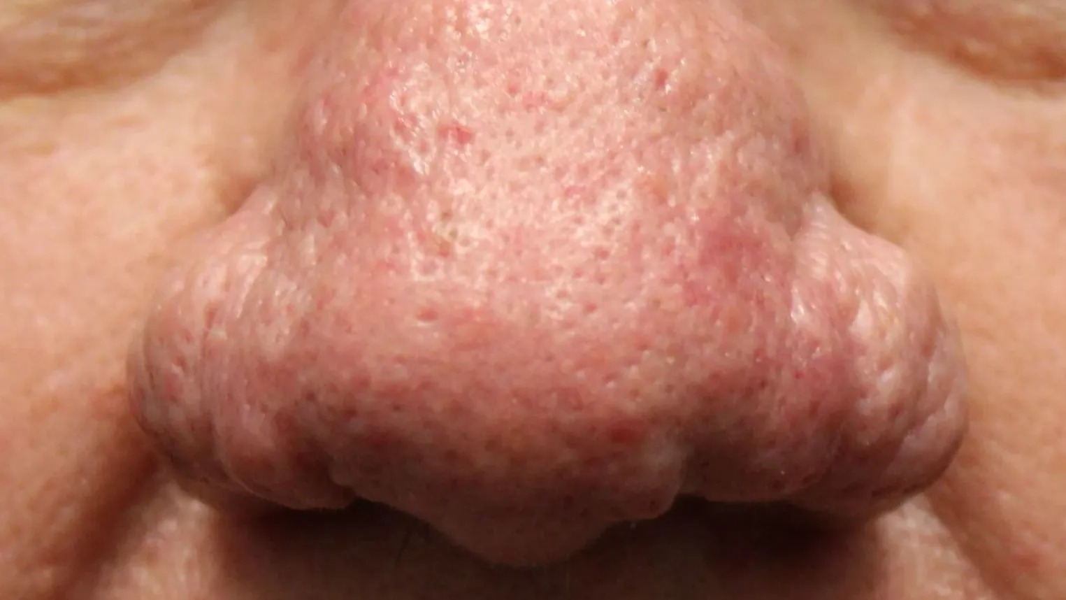 HT17. Rhinophyma: Causes, Symptoms, and Treatment