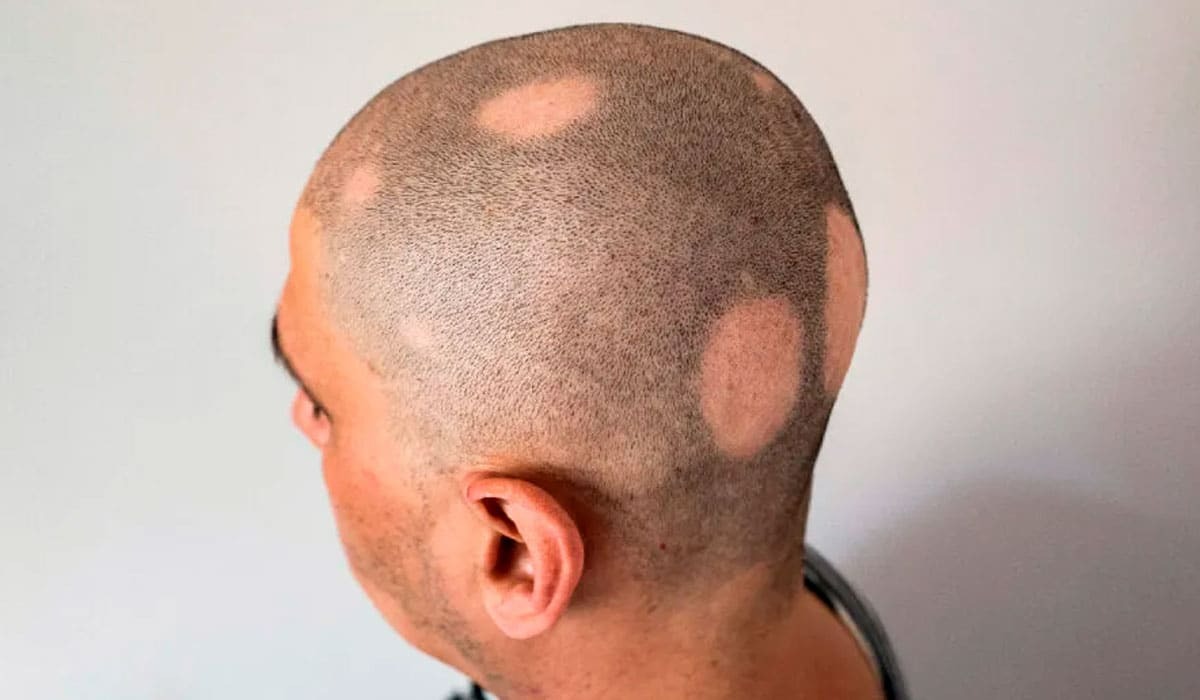 HT17. Why Is Your Hair Falling Out in Round Patches?