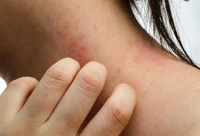 HT17. Mysterious Red Bumps on Skin: What Could They Mean?
