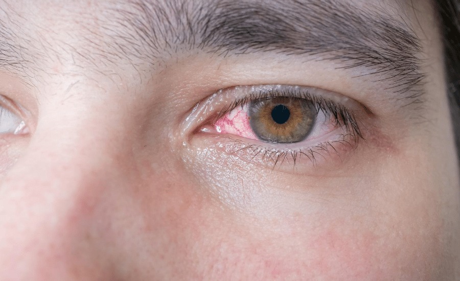 HT17. Traumatic Eye Injuries: Causes, Symptoms, and Why Immediate Care Matters