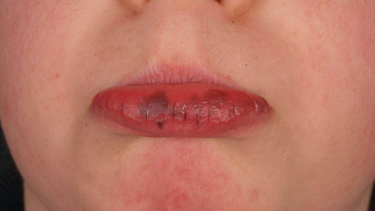 HT17. Peutz-Jeghers Syndrome: The Rare Condition That Starts With Dark Spots in the Mouth