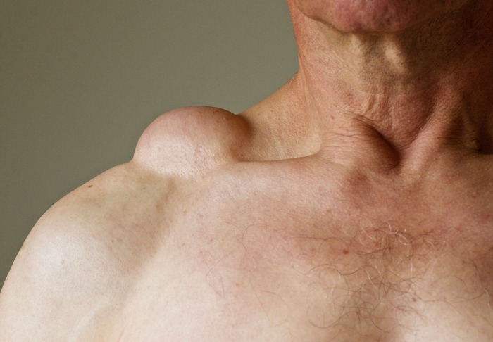 HT17. Doctors Couldn’t Believe What Was Inside This Swelling… See for Yourself