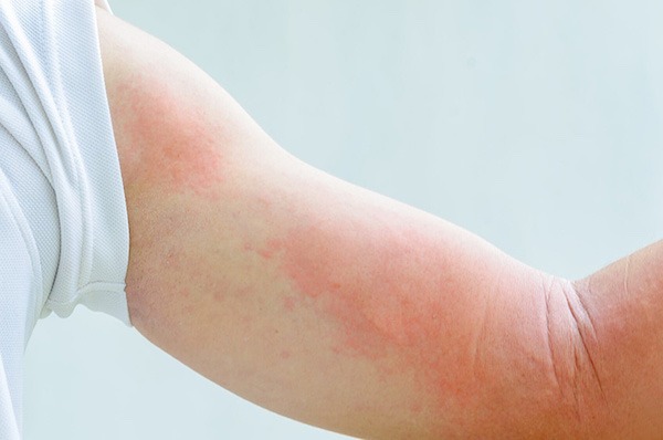 HT17. His Whole Body Was Itchy: What She Thought Was a Common Allergy Was Hiding Something More Serious